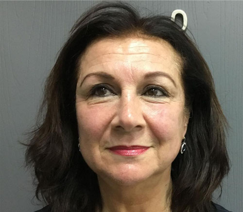 Full Face Rejuvenation