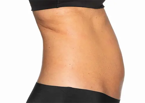 Photo of patient before coolsculpting treatment