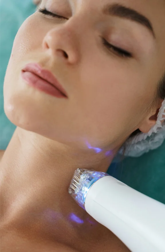 Woman getting microneedling - RF Microneedling