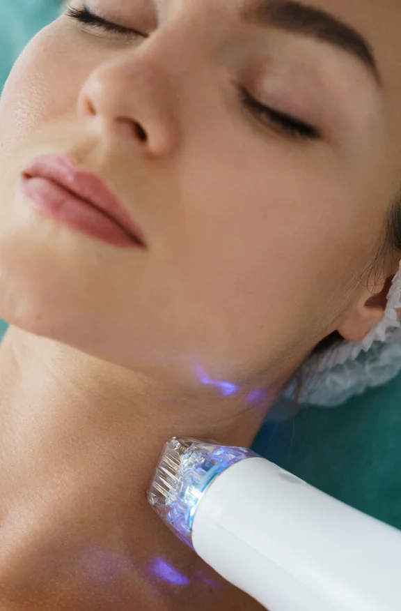 Woman getting microneedling - Microneedling