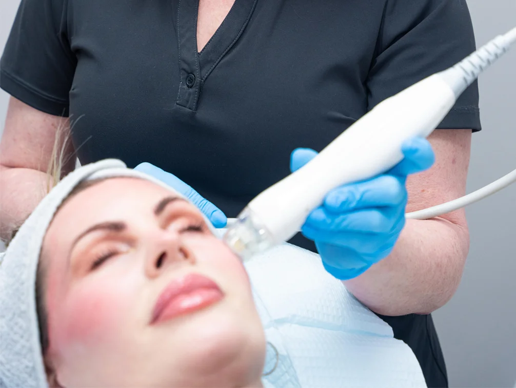 Woman getting microneedling - RF Microneedling