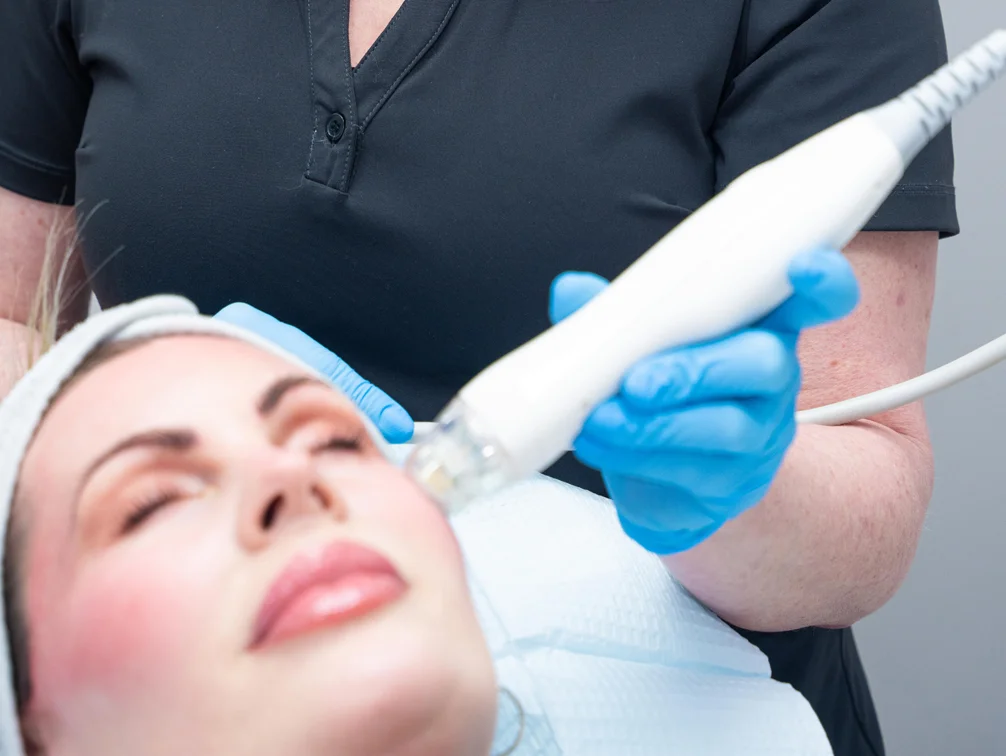 Woman getting microneedling - Microneedling