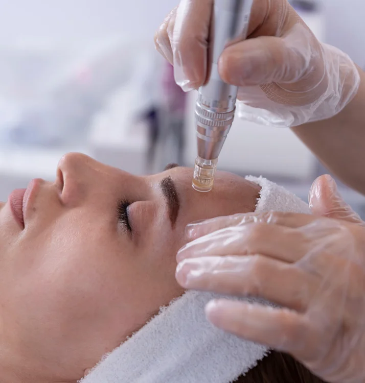 Microneedling on forehead - Microneedling