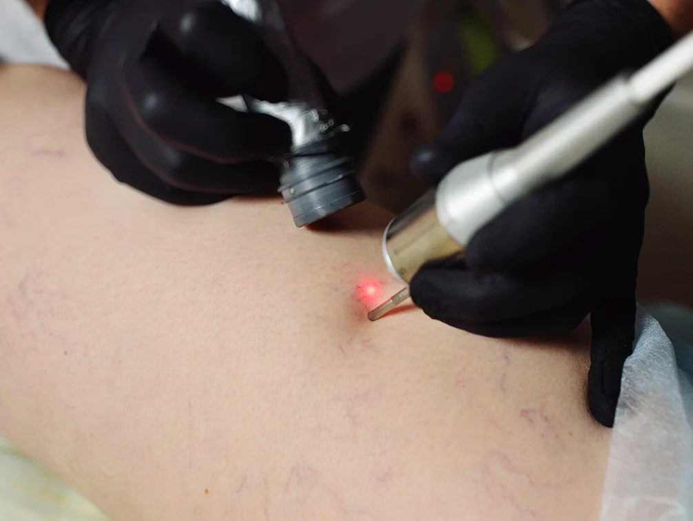 Close up of patient getting laser vein removal