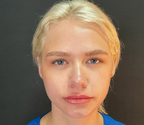 BOTOX