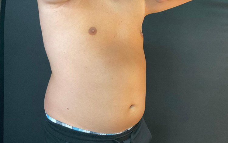 Photo of patient after coolsculpting treatment